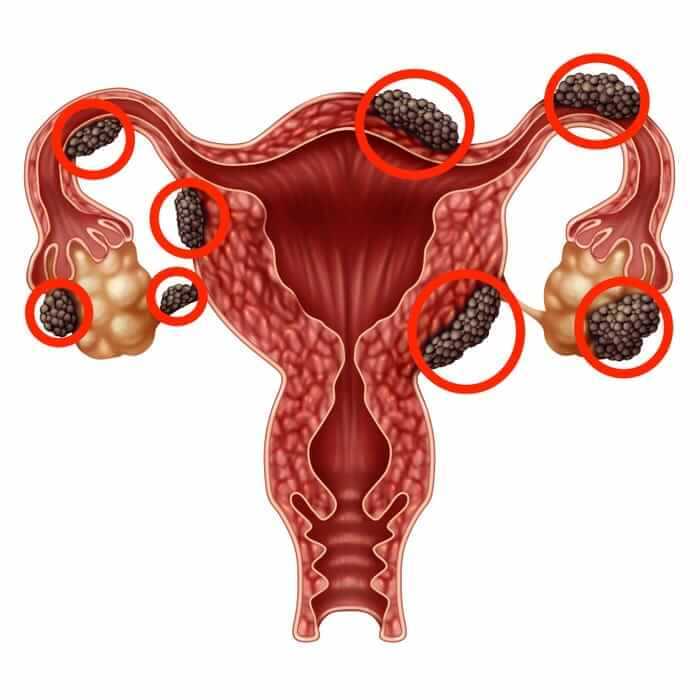 Endometriotic Cyst Removal Endometriotic Cyst Removal