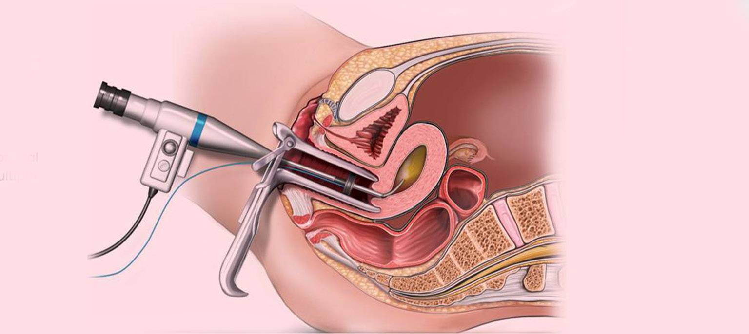 Hysteroscopy Hysteroscopy