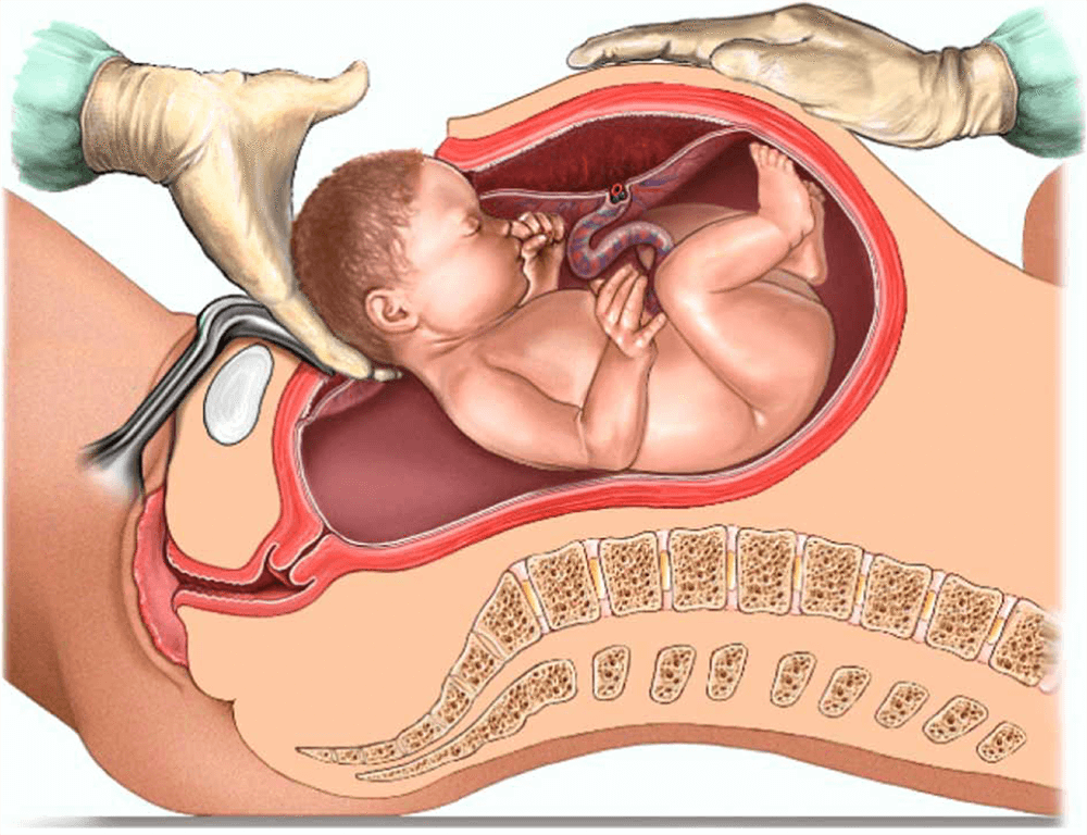 Caesarean Section (C-Section) Delivery in Coimbatore Caesarean Section (C-Section) Delivery in Coimbatore